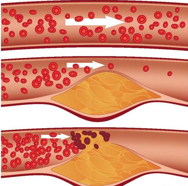 С����ؓ���x���܉򌦸�Ѫ֬�ķ��ΰl�]�@����Ҋ��Ӱ�